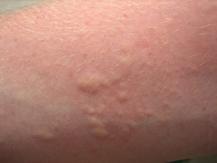 itchy allergic skin rashes can be symptoms of ascariasis