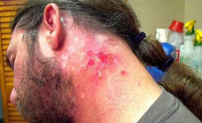 Bleeding wound on the neck with Morgellon virus