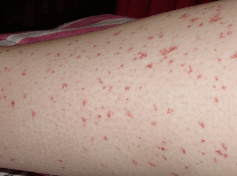 Skin rash is a sign of an acute stage of worm infection